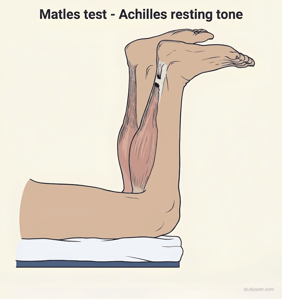 Two-panel examination diagram showing Matles test with patient prone and knees flexed to 90 degrees comparing normal foot in slight plantarflexion to positive test with foot in neutral or dorsiflexion indicating Achilles rupture
