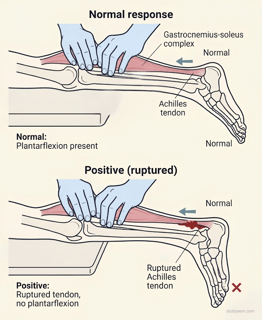 Two-panel examination diagram showing Simmonds-Thompson calf squeeze test with normal plantarflexion response on the left and absent plantarflexion indicating complete Achilles rupture on the right
