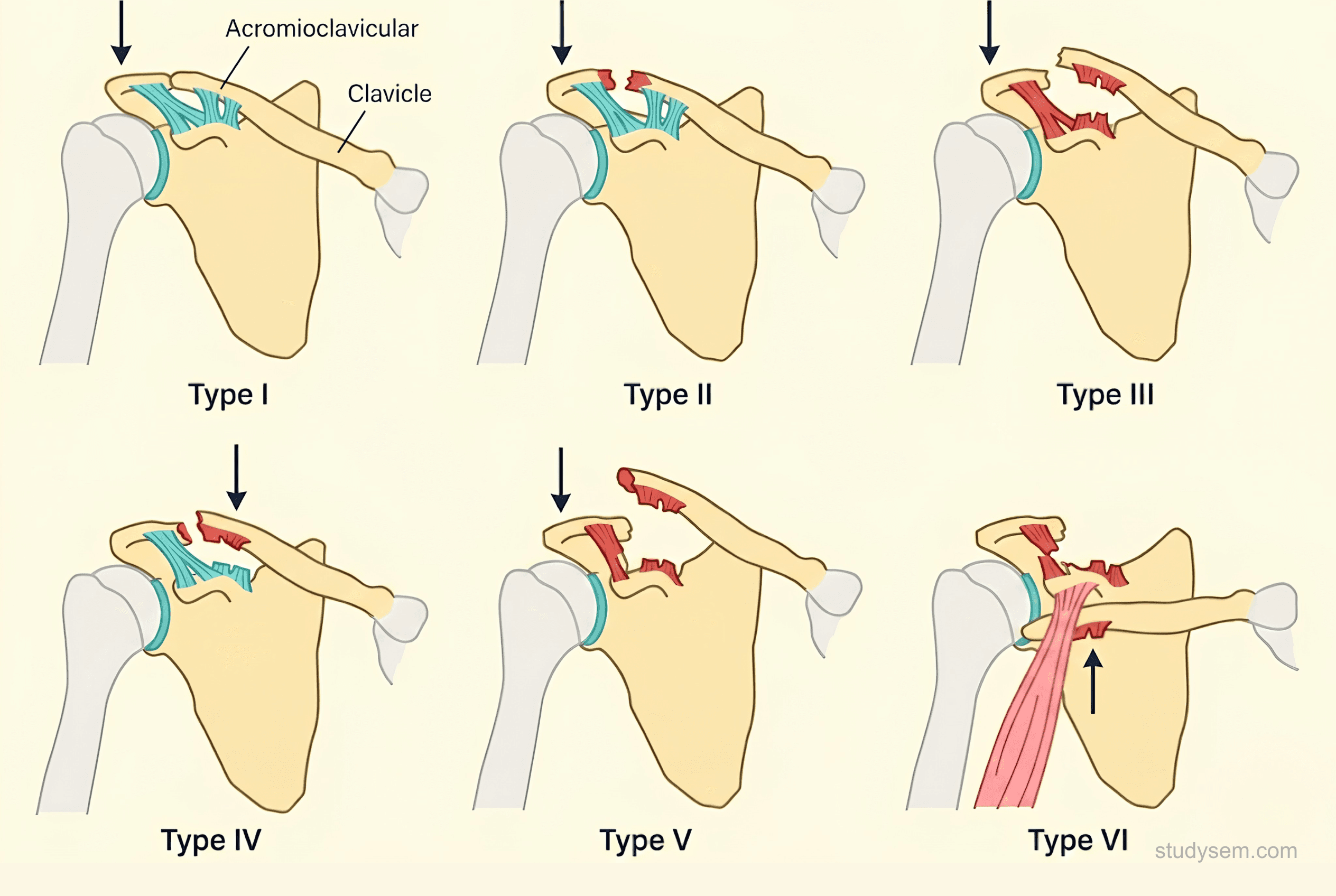 Six-panel diagram of the Rockwood classification of acromioclavicular joint injury, showing the progressive disruption of the AC ligament, coracoclavicular ligaments, and deltotrapezial fascia from Grade I (sprain) through Grade VI (inferior displacement of the clavicle).