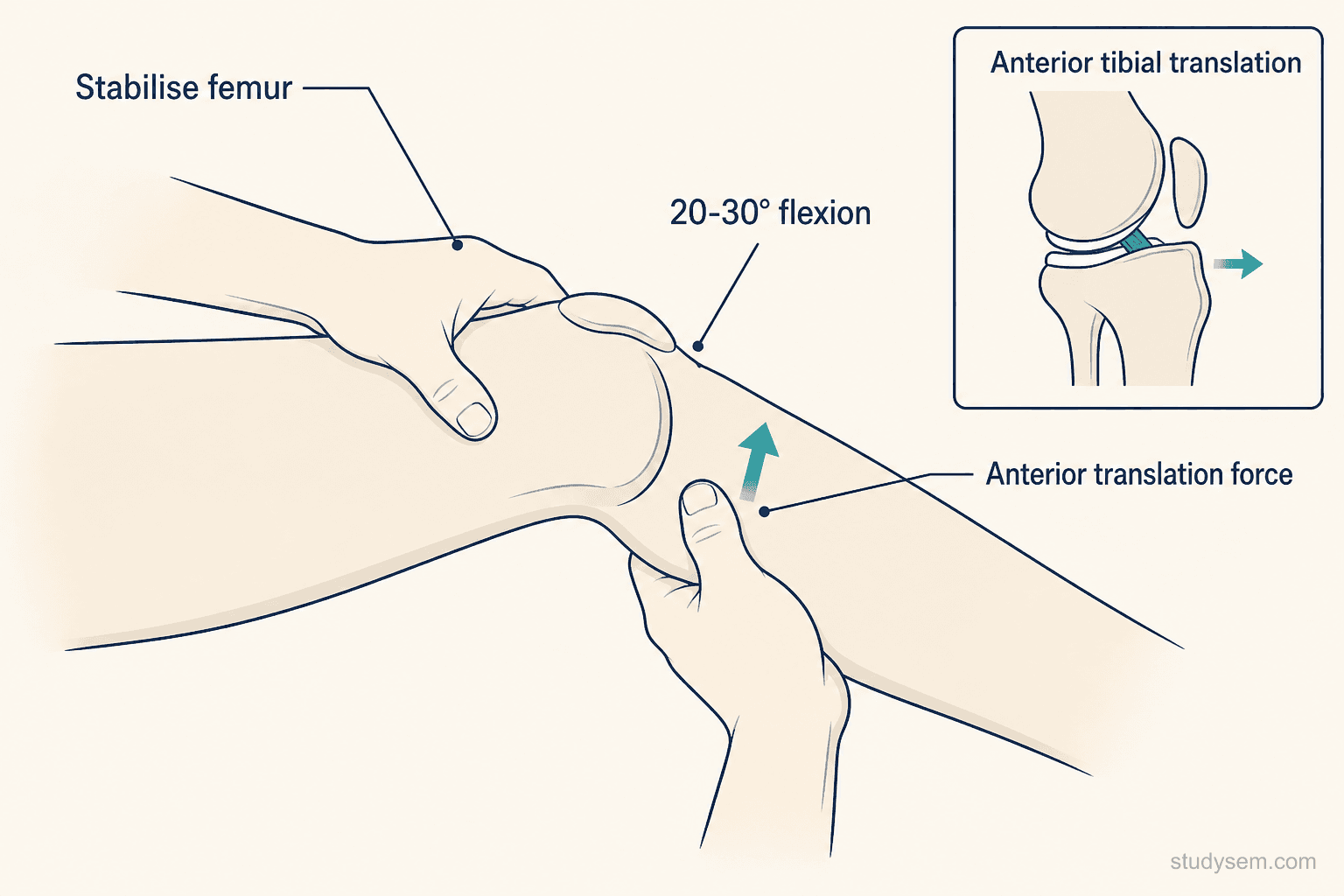 Illustration of the Lachman test - patient supine with knee at 20-30 degrees flexion, examiner stabilises the distal femur and translates the proximal tibia anteriorly, with an inset showing increased anterior tibial translation