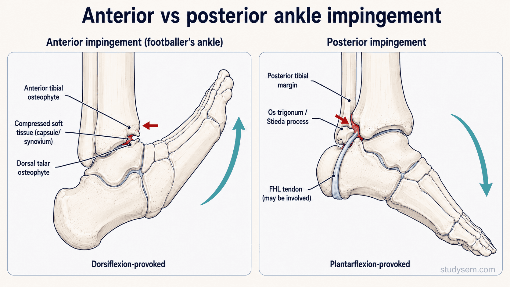 Two-panel comparative diagram showing anterior ankle impingement with tibial and talar osteophytes compressed during dorsiflexion on the left and posterior impingement with os trigonum compressed during plantarflexion on the right