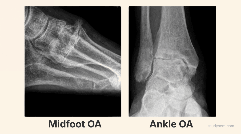 AI-generated X-ray images showing midfoot osteoarthritis with tarsometatarsal joint space narrowing and dorsal osteophytes alongside ankle osteoarthritis with tibiotalar joint space narrowing