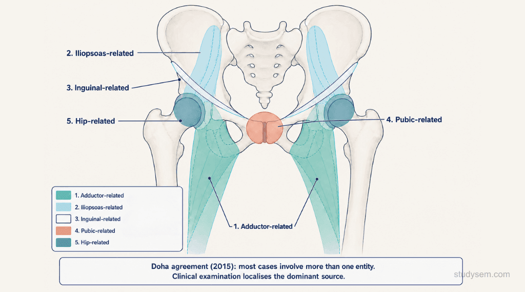Anterior pelvis diagram showing the Doha agreement five clinical entities of athletic groin pain: adductor-related, iliopsoas-related, inguinal-related, pubic-related, and hip-related regions