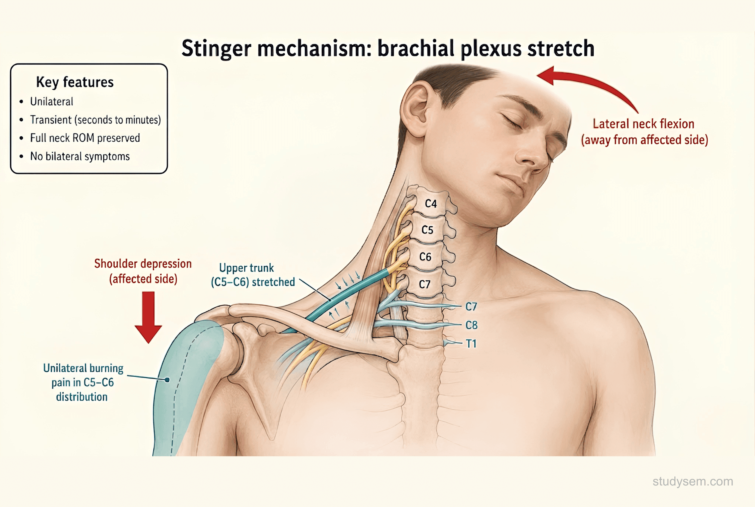 Stinger mechanism showing lateral neck flexion and shoulder depression stretching the upper trunk C5-C6 of the brachial plexus producing unilateral transient burning pain