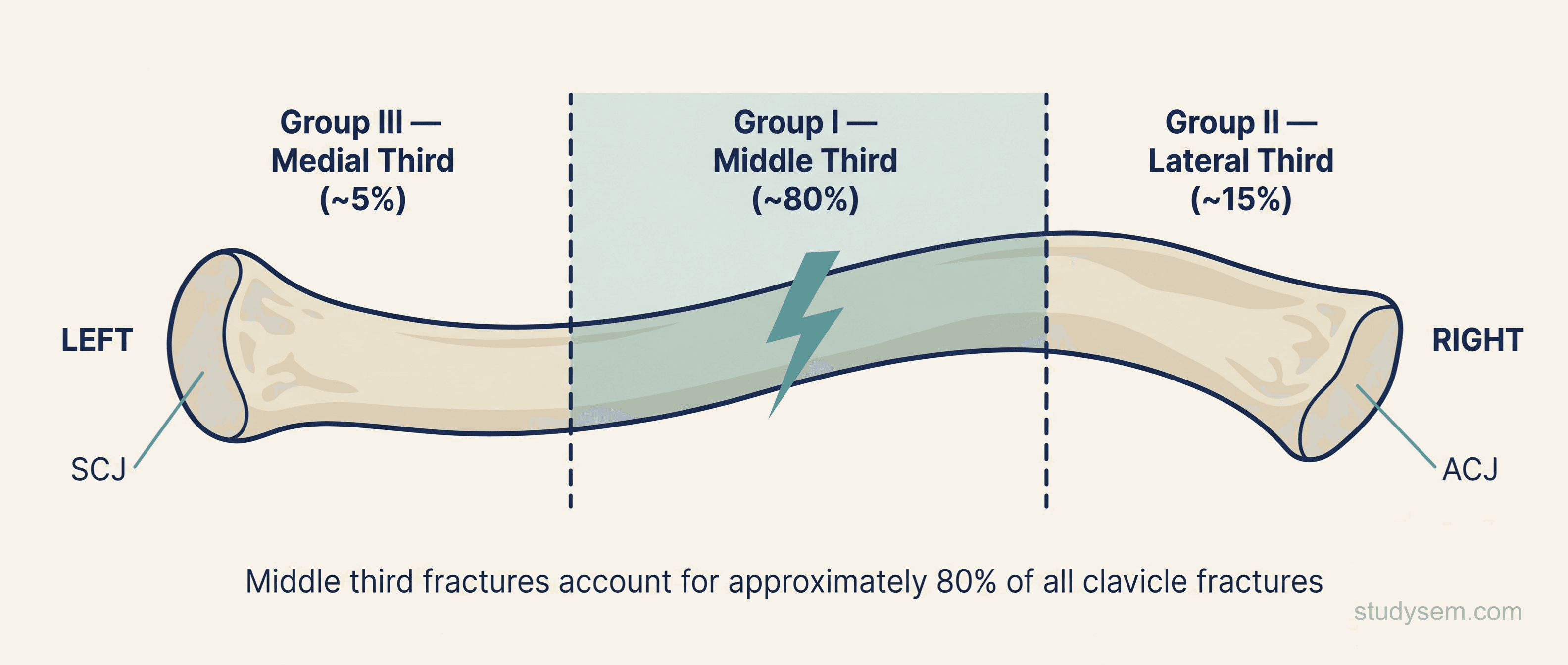 Allman classification of clavicle fractures showing Group I middle third, Group II lateral third, and Group III medial third.