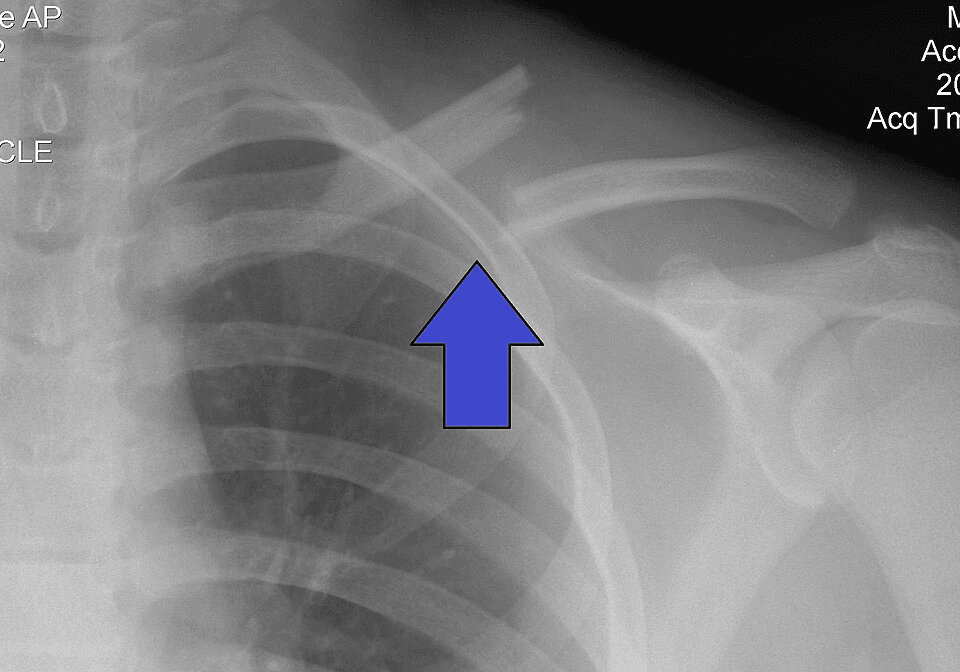 AP radiograph of a displaced midshaft clavicle fracture in an adult.