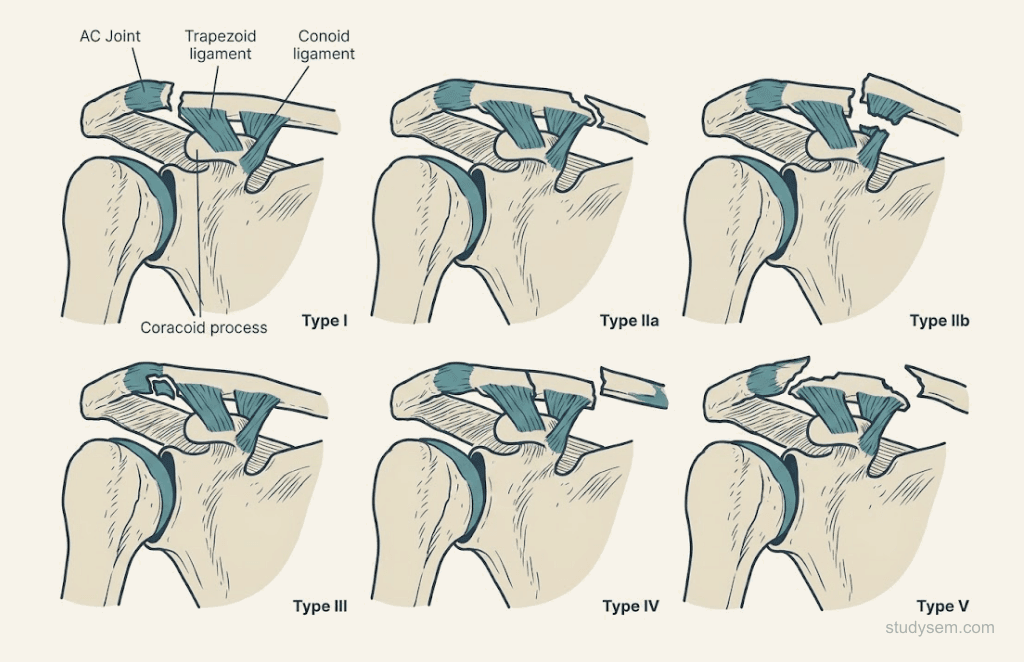 Diagram of the Neer classification for lateral clavicle fractures showing all five types.