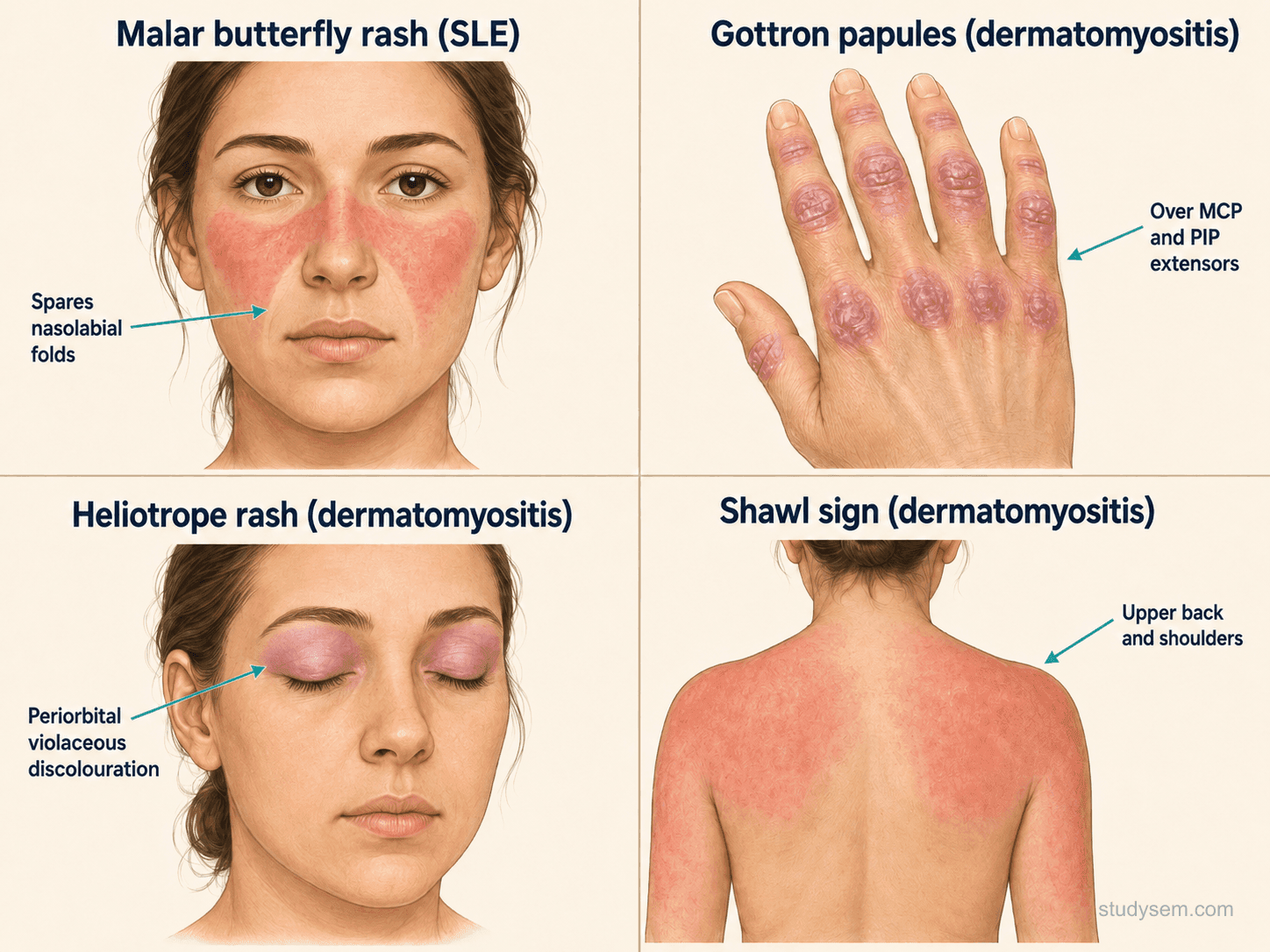 Multi-panel diagram of cutaneous signs: SLE malar butterfly rash sparing the nasolabial folds; dermatomyositis Gottron papules over the MCP and PIP knuckles; heliotrope violaceous rash of the upper eyelids; and shawl sign over the upper back, posterior neck, and shoulders