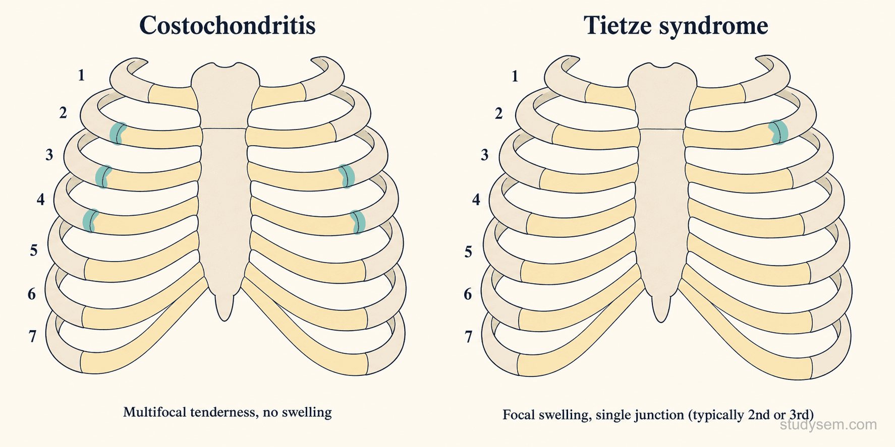 Anterior chest wall comparison showing costochondritis with multiple costochondral junctions affected without swelling, versus Tietze syndrome with focal swelling at a single costochondral junction.