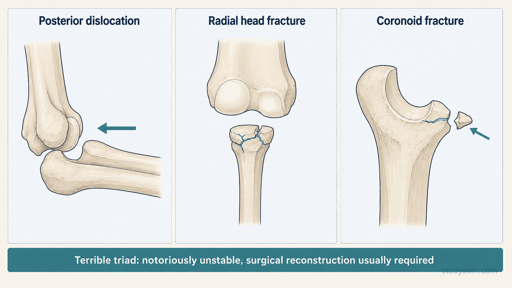 Terrible triad of the elbow showing posterior dislocation with radial head fracture and coronoid fracture.