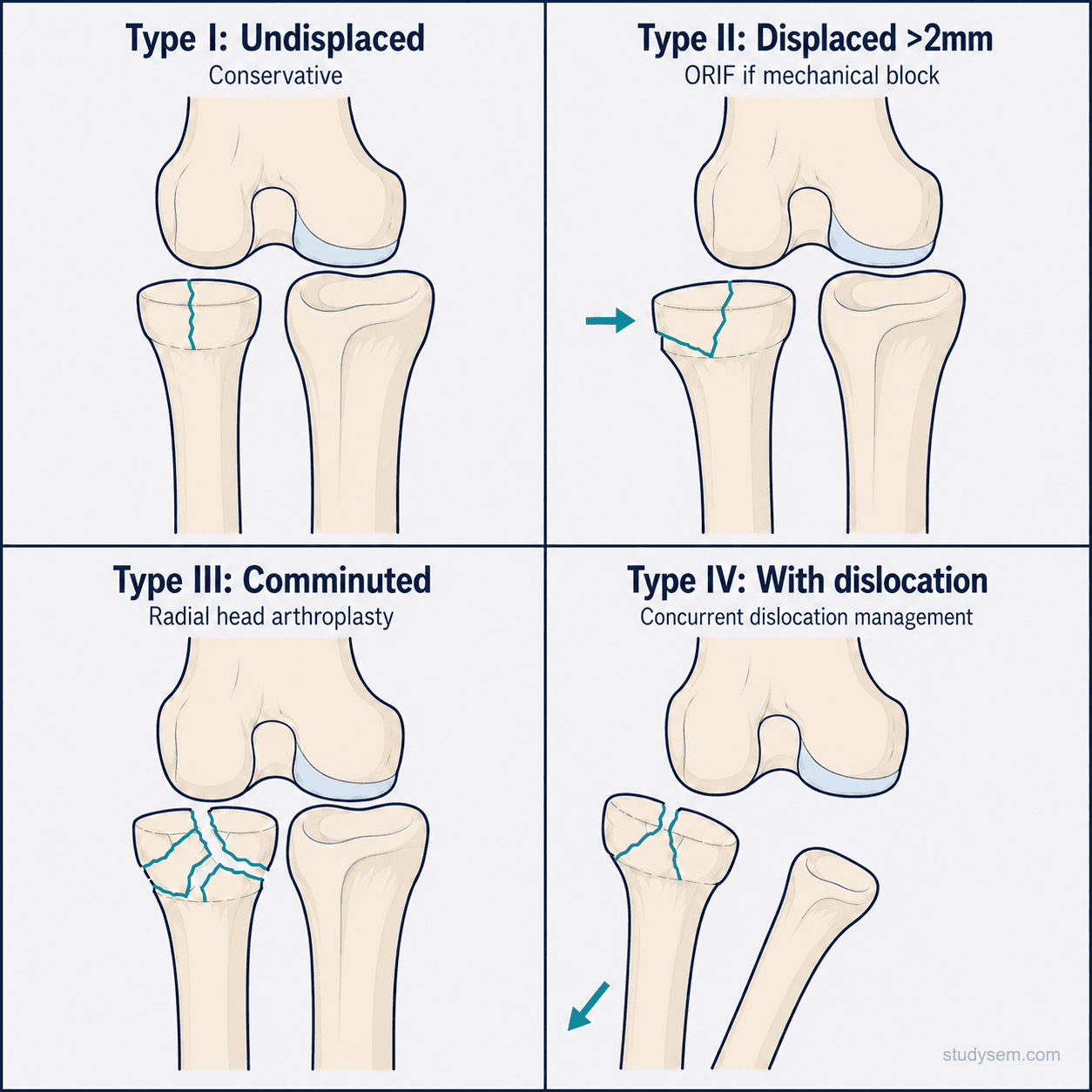 Mason classification of radial head fractures showing four types from undisplaced through comminuted to fracture with dislocation.