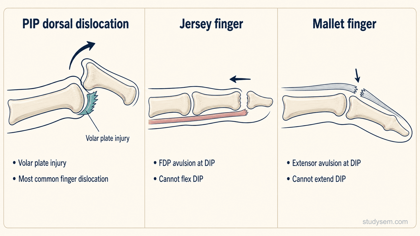 Three-panel lateral finger diagram comparing PIP dorsal dislocation with volar plate injury, jersey finger with FDP avulsion at the DIP, and mallet finger with terminal extensor avulsion at the DIP.