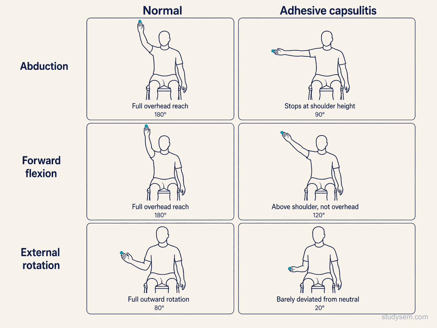 Six-panel comparative diagram showing the capsular pattern of restriction in adhesive capsulitis: external rotation disproportionately restricted, abduction moderately restricted, forward flexion least affected.