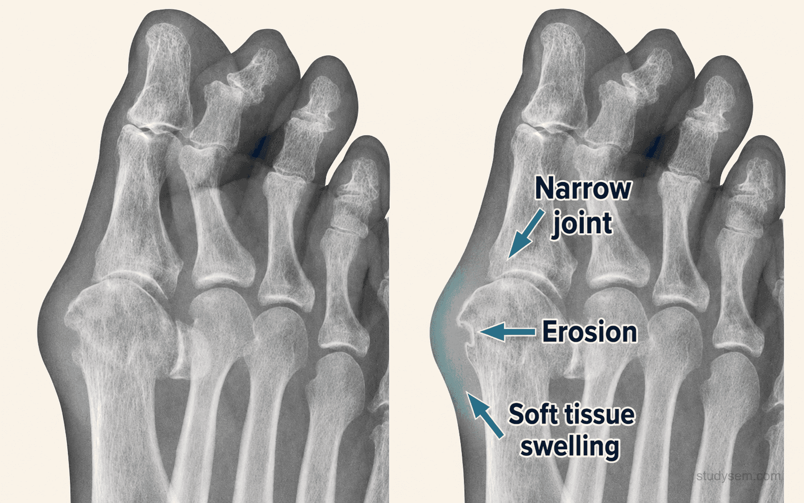 Plain radiograph of the first metatarsophalangeal joint in chronic tophaceous gout showing a periarticular punched-out erosion with sclerotic overhanging edges (Martel's sign) and preserved adjacent bone density