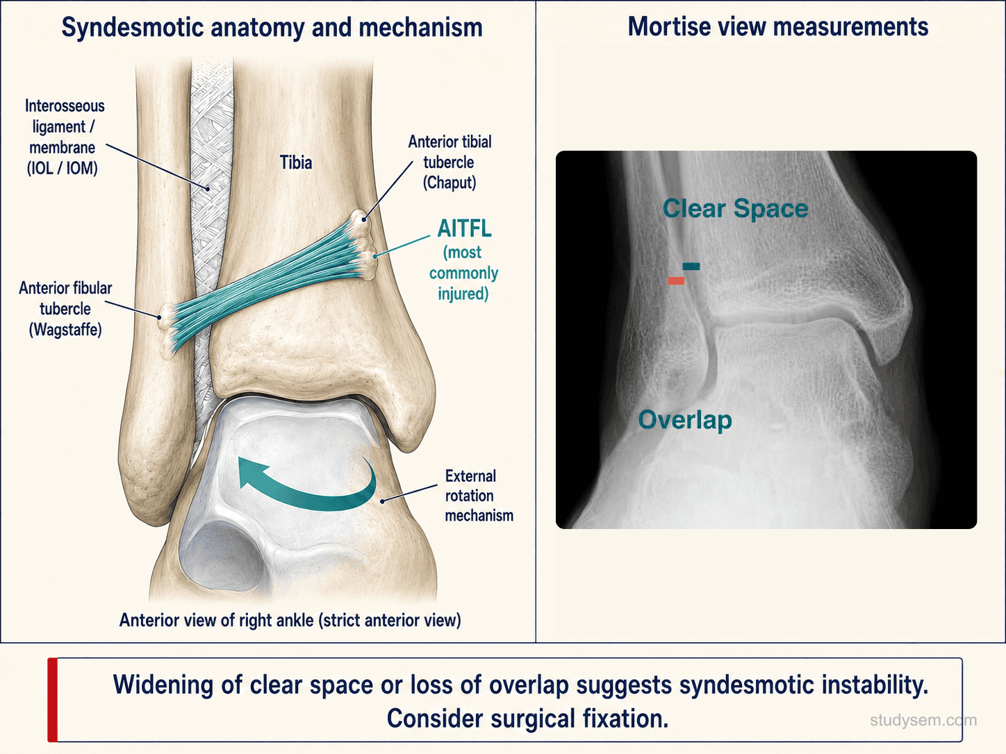 Distal tibiofibular syndesmosis anatomy paired with a mortise-view radiograph showing the measurement landmarks for tibiofibular clear space, tibiofibular overlap, and medial clear space