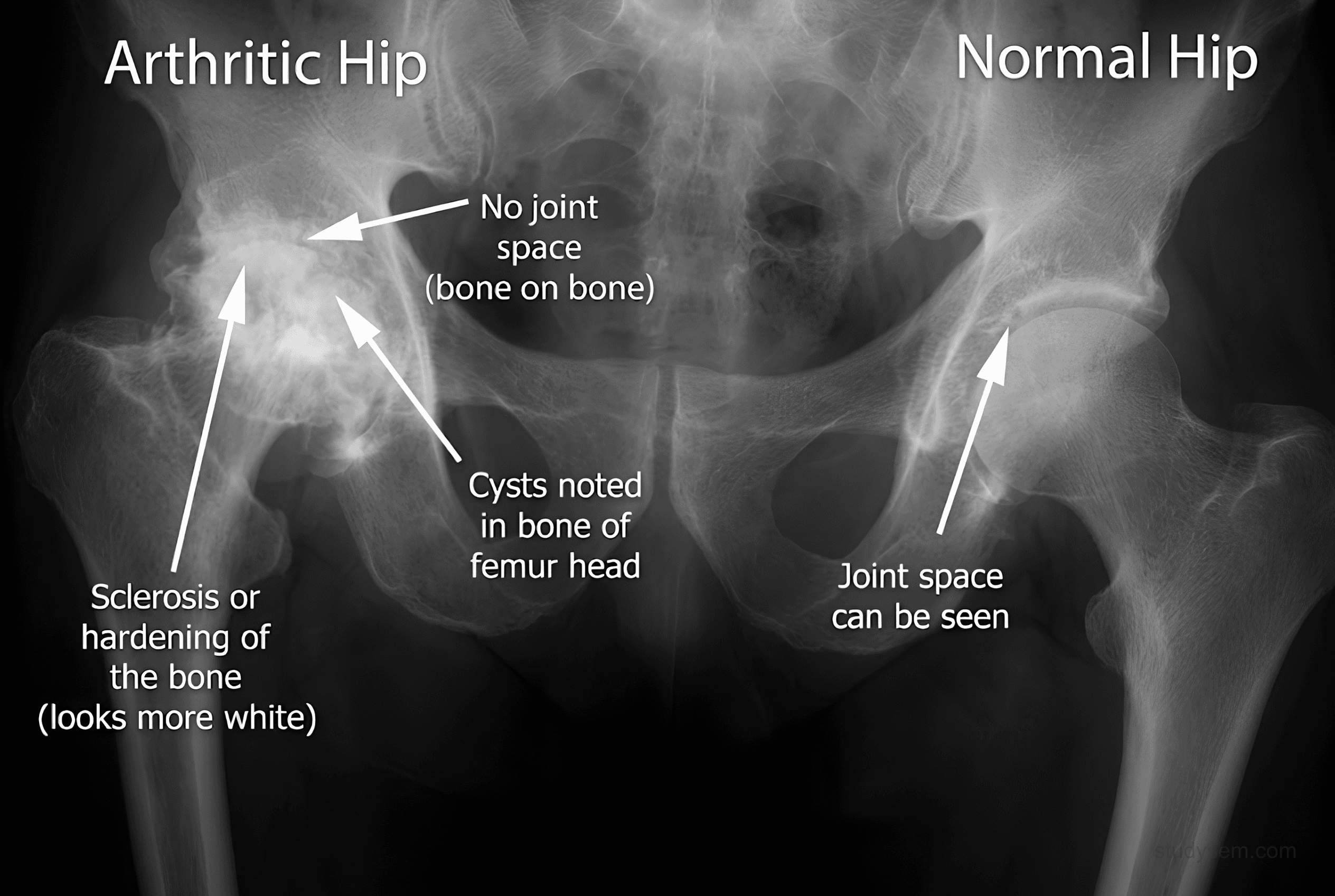 AP pelvis X-ray showing hip osteoarthritis on one side with joint space narrowing, subchondral sclerosis, osteophytes, and subchondral cysts compared to the normal contralateral hip