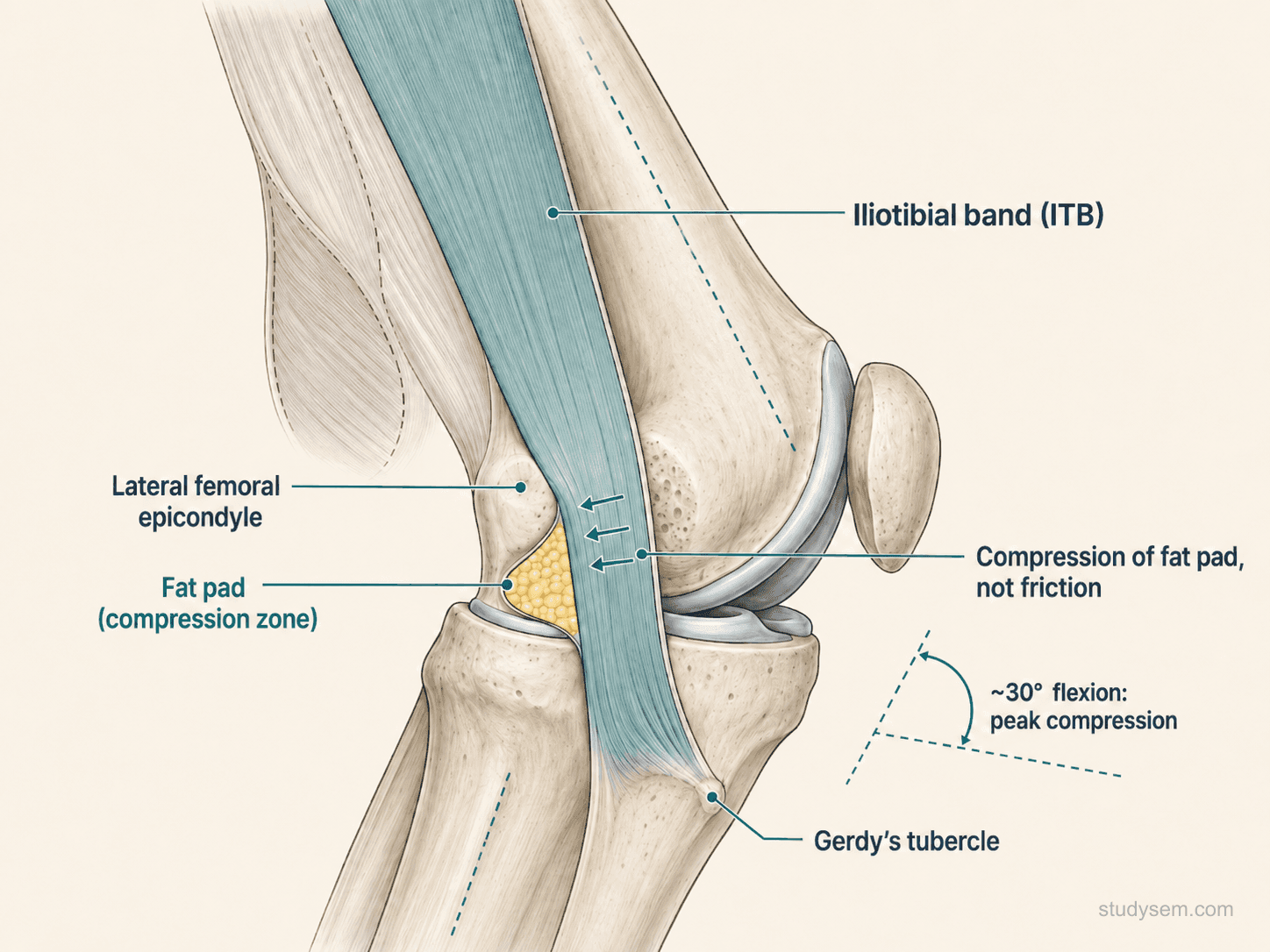 Lateral view of knee showing iliotibial band compressing against the lateral femoral epicondyle at 30 degrees flexion with underlying fat pad