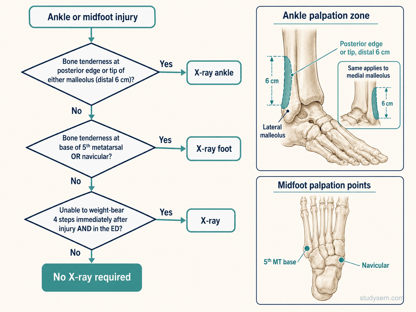Ottawa Ankle Rules decision flowchart showing malleolar zone tenderness, midfoot tenderness at 5th metatarsal base or navicular, and inability to weight-bear 4 steps as indications for X-ray with palpation zone diagrams