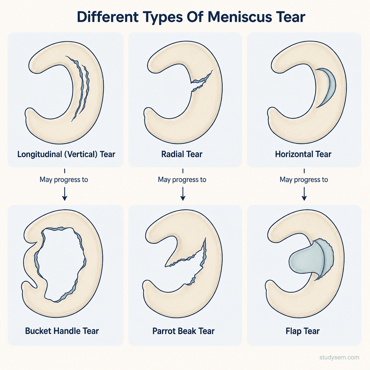 Six common meniscal tear patterns shown from above: longitudinal, bucket-handle, radial, horizontal cleavage, flap, and complex degenerative