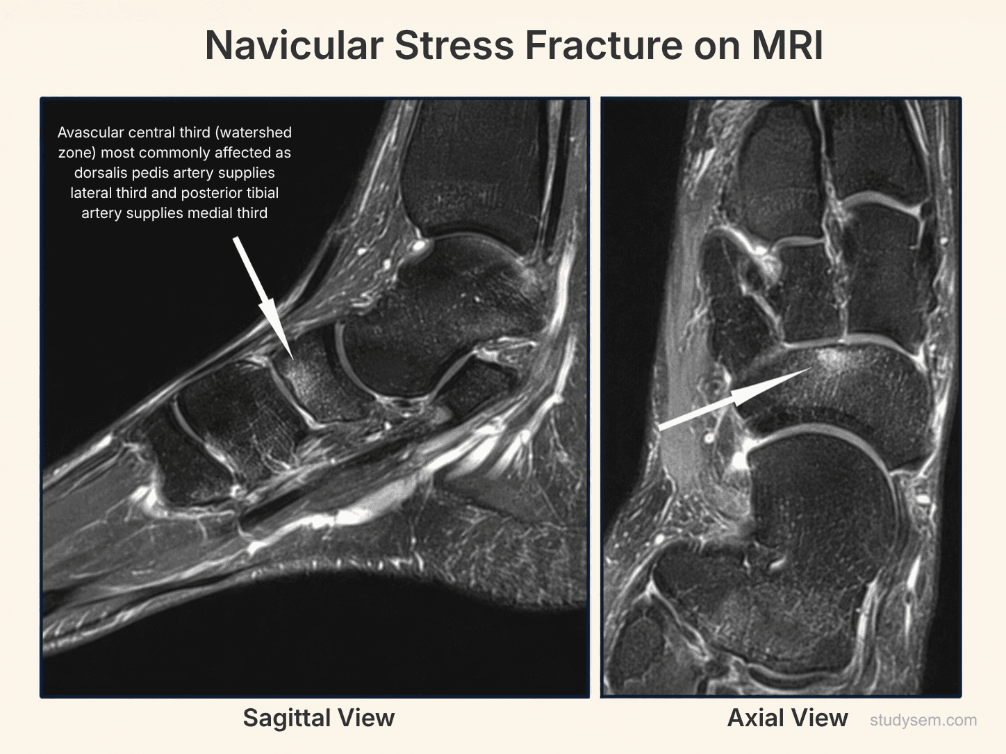 Coronal MRI of the navicular highlighting the avascular central third (watershed zone) where stress fractures classically occur, with the typical sagittal fracture line through this zone