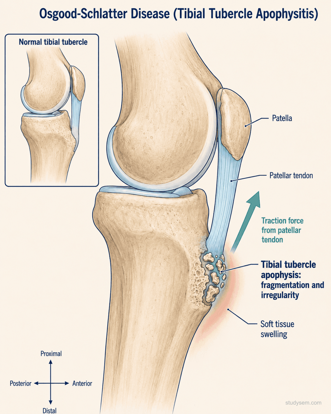 AI-generated lateral knee diagram showing Osgood-Schlatter disease with fragmentation and irregularity of the tibial tubercle apophysis from repeated patellar tendon traction