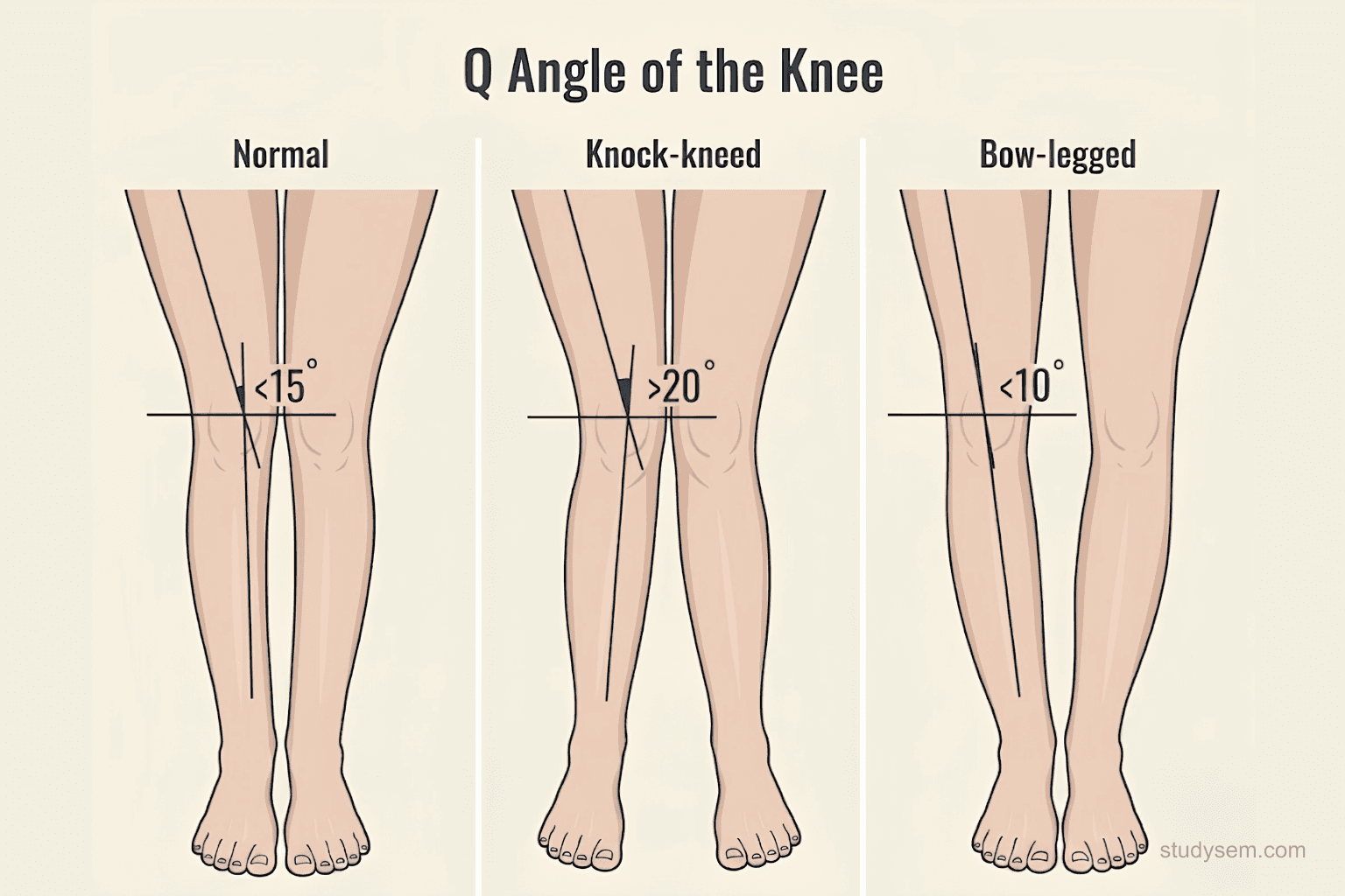 Q-angle measurement diagram showing line from ASIS to patella centre to tibial tubercle with normal and increased angles