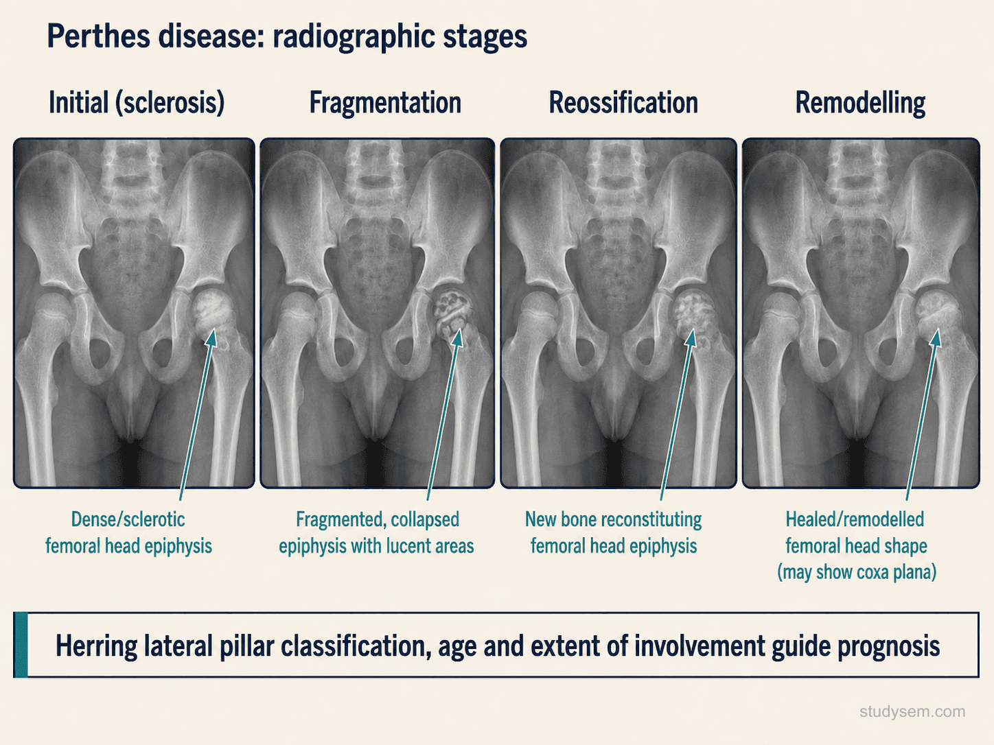 Four-panel paediatric AP pelvis radiograph diagram showing the Waldenström stages of Perthes disease: initial sclerosis of the capital femoral epiphysis with relative increased density; fragmentation with epiphyseal lucencies and femoral head flattening; reossification with progressive new bone formation; and remodelling with residual deformity (coxa plana, coxa magna). Caption notes the Catterall and Herring lateral pillar classifications applied during fragmentation guide prognosis.