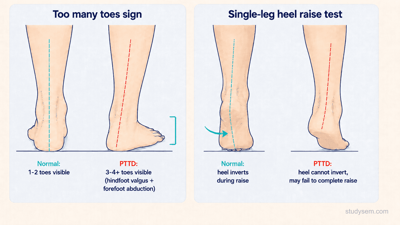 Two-panel examination diagram showing the too many toes sign from behind with hindfoot valgus and forefoot abduction on the left and failed single-leg heel raise with absent heel inversion on the right