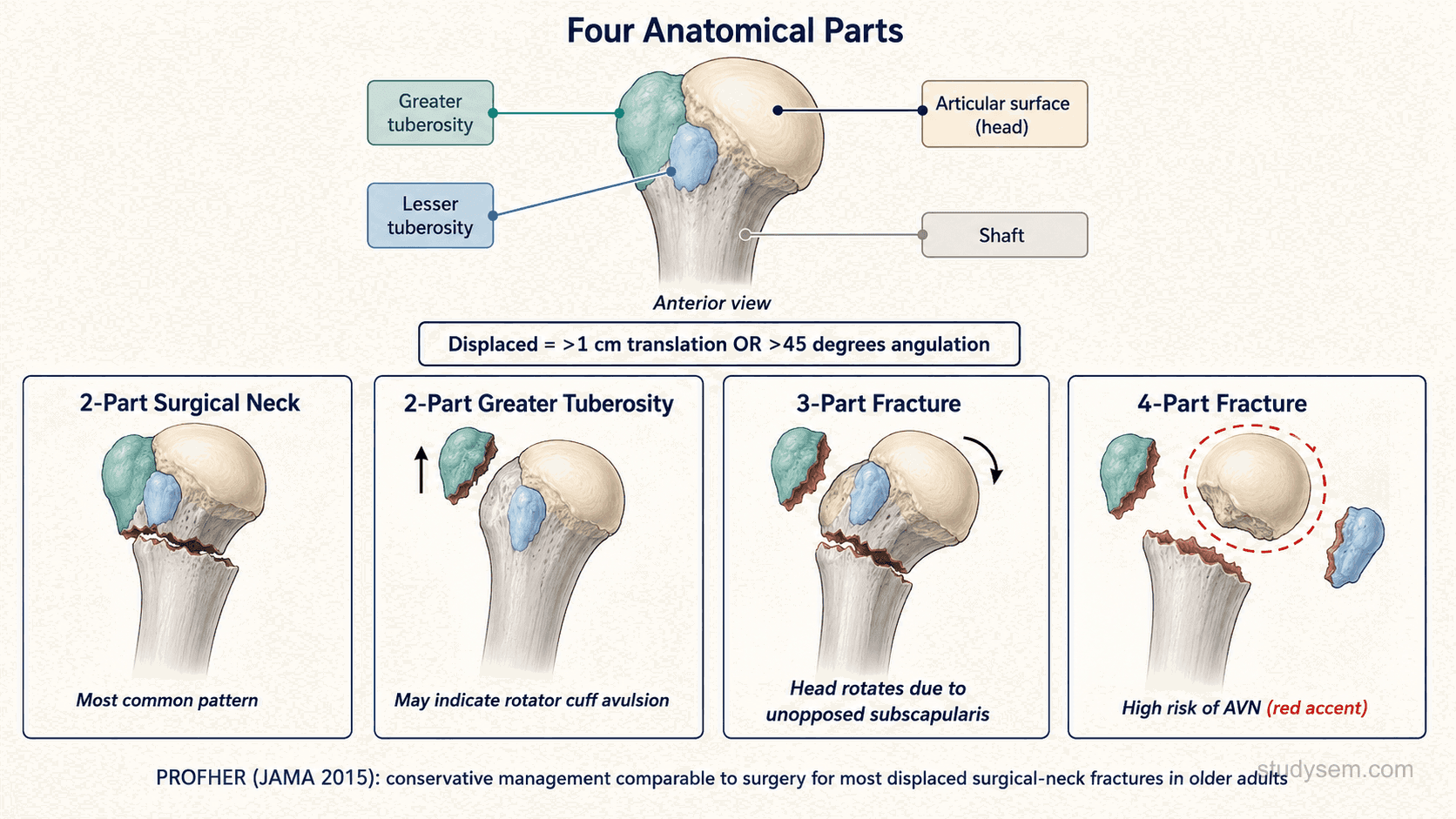 Diagram of the Neer 4-part classification of proximal humerus fractures.