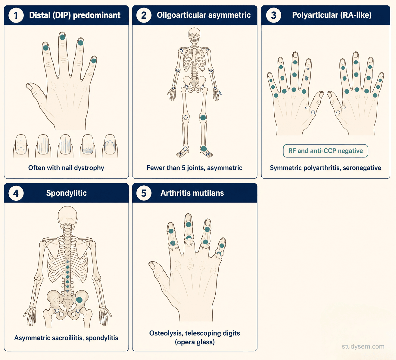 Five-panel diagram of the Moll and Wright psoriatic arthritis patterns: asymmetrical oligoarthritis with dactylitis, symmetrical polyarthritis resembling RA, DIP-predominant pattern with adjacent nail change, spondylitis with sacroiliitis, and arthritis mutilans with telescoping digits and pencil-in-cup deformity