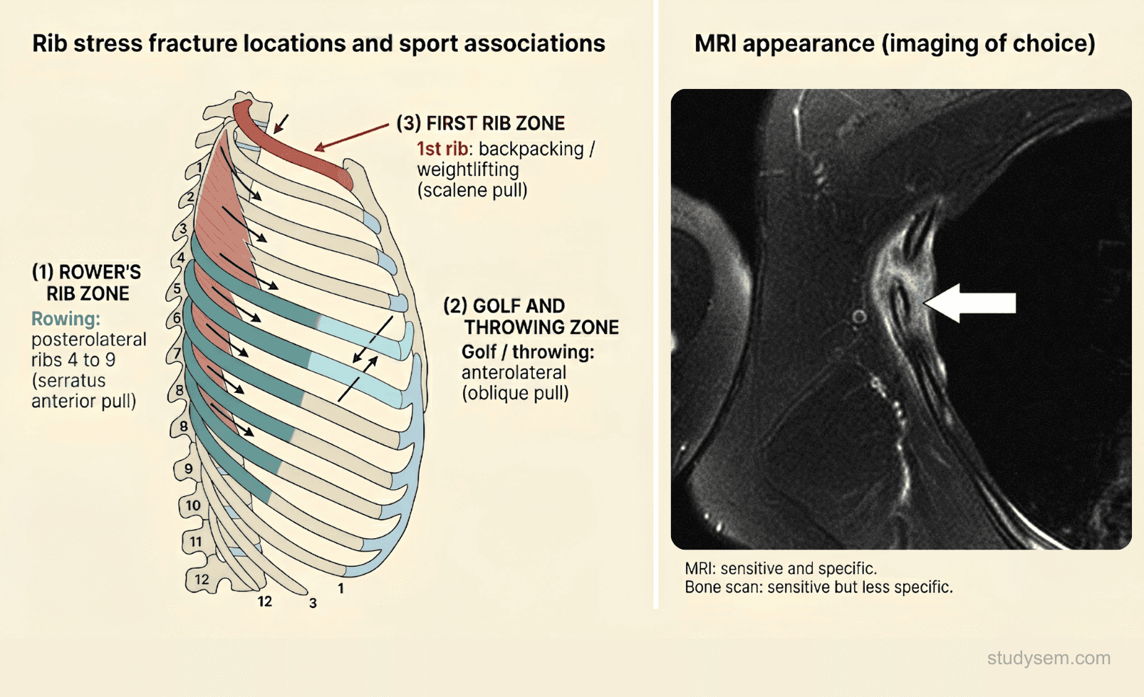 Posterolateral rib cage diagram showing the classic rower stress fracture distribution (4th to 9th ribs at the serratus anterior attachment) paired with MRI demonstrating bone marrow oedema and periosteal reaction