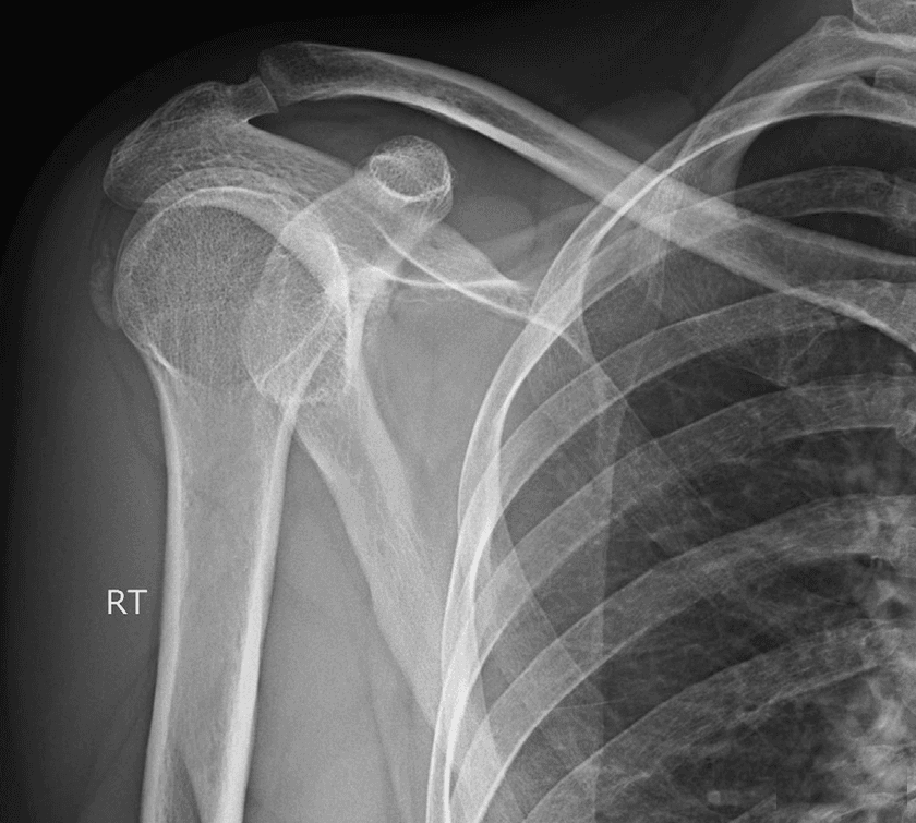 AP shoulder radiograph demonstrating a calcific deposit in the supraspinatus tendon.