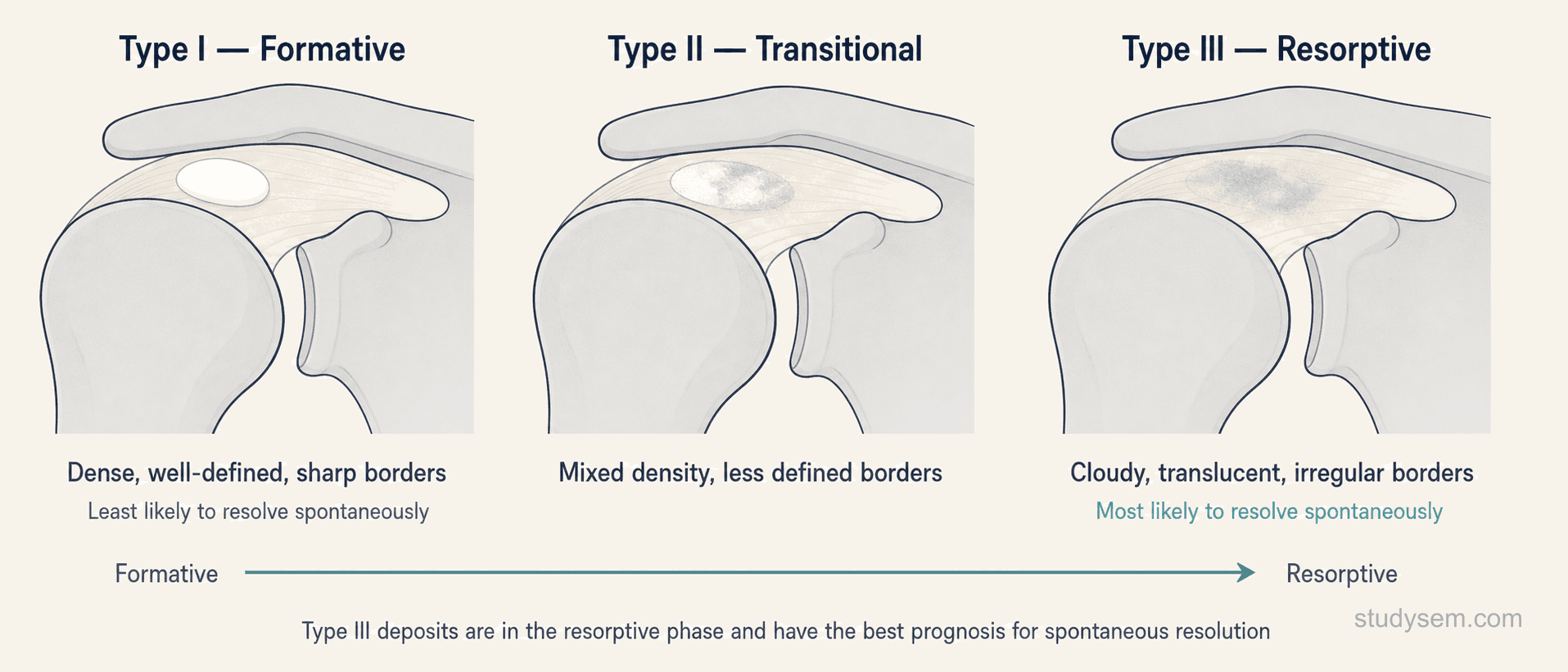 Gartner radiographic classification of calcific deposits Types I to III.