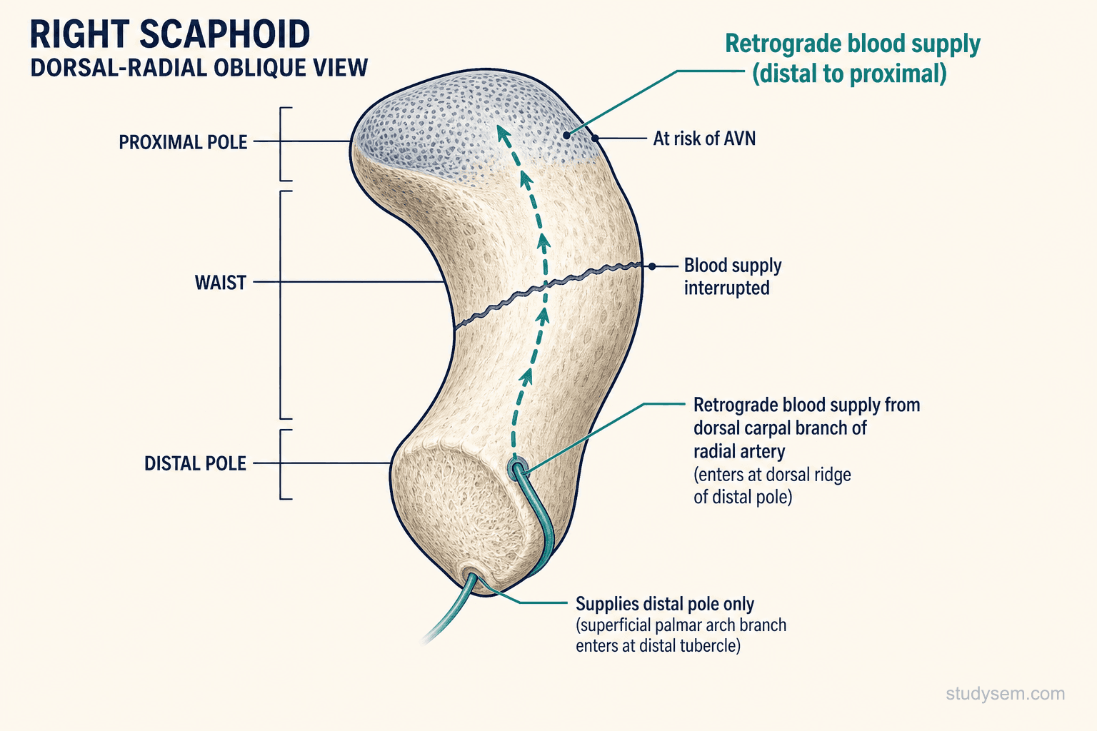 Scaphoid bone showing retrograde blood supply from the dorsal carpal branch entering distally and running proximally with waist fracture line interrupting flow to the proximal pole.
