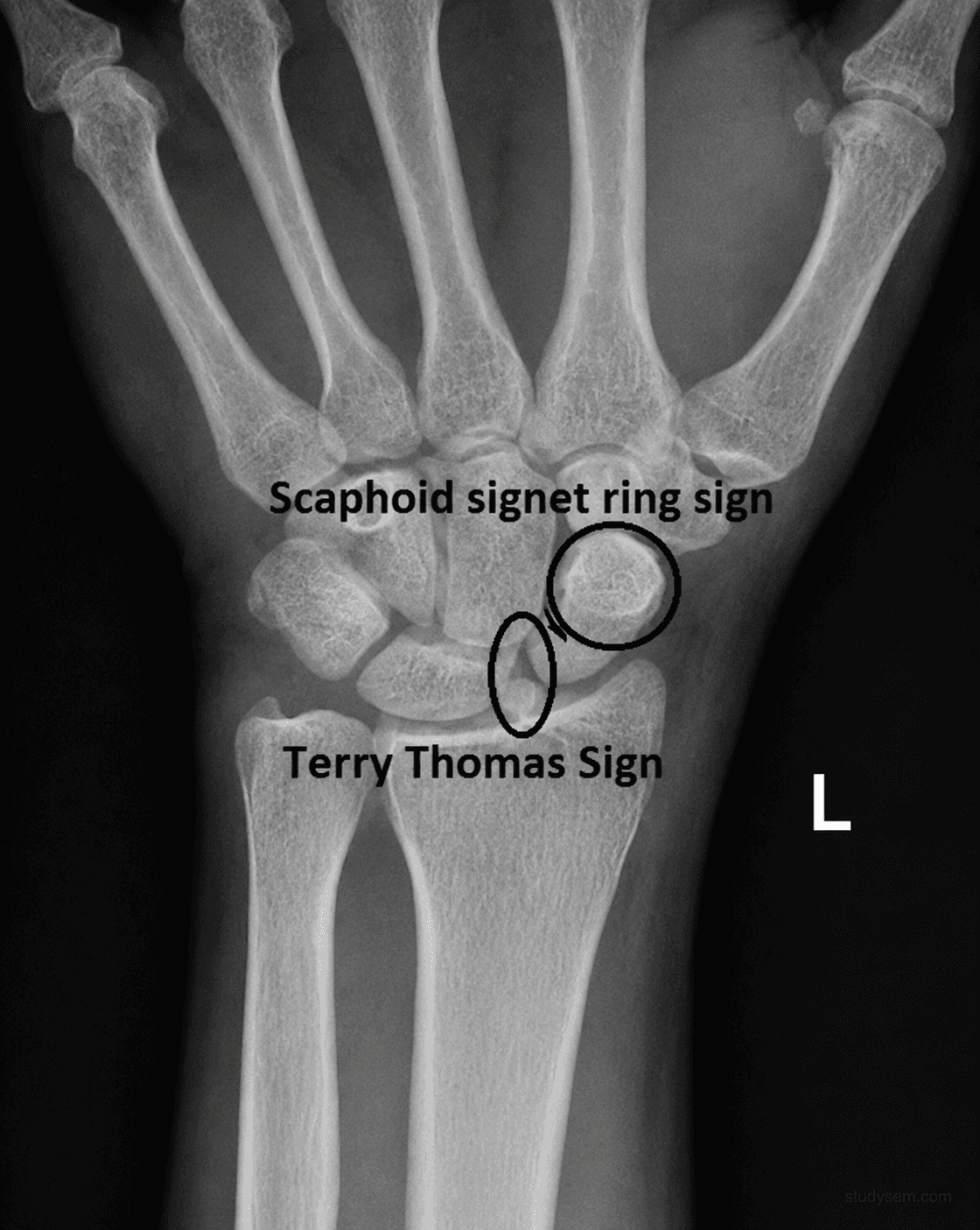 PA wrist radiograph showing Terry Thomas sign with scapholunate gap widened beyond 3 mm and signet ring sign from the cortical ring of the rotated scaphoid.
