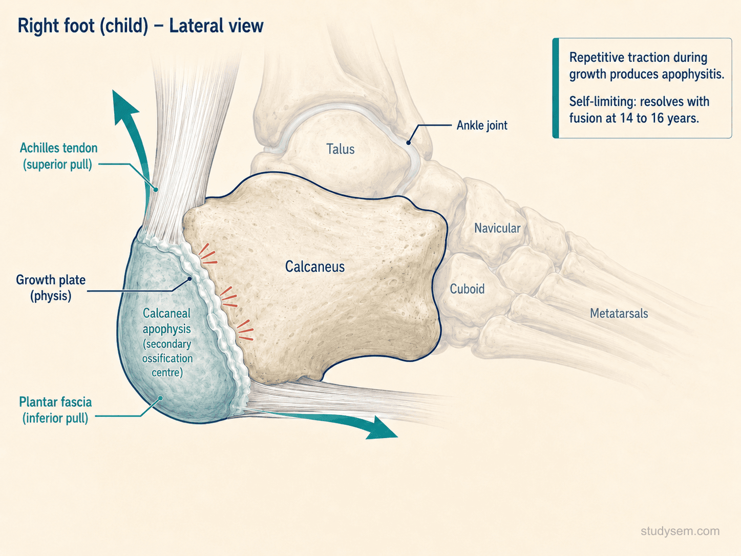 Lateral diagram of a paediatric foot and ankle showing the calcaneal secondary ossification centre (apophysis) at the posterior calcaneus. Achilles tendon insertion produces traction force on the apophysis; plantar fascia origin contributes to the local mechanical environment. Arrows depict repetitive traction during running and jumping and compressive heel-strike force. Caption notes the condition is self-limiting and resolves with apophyseal fusion at 14-16 years.