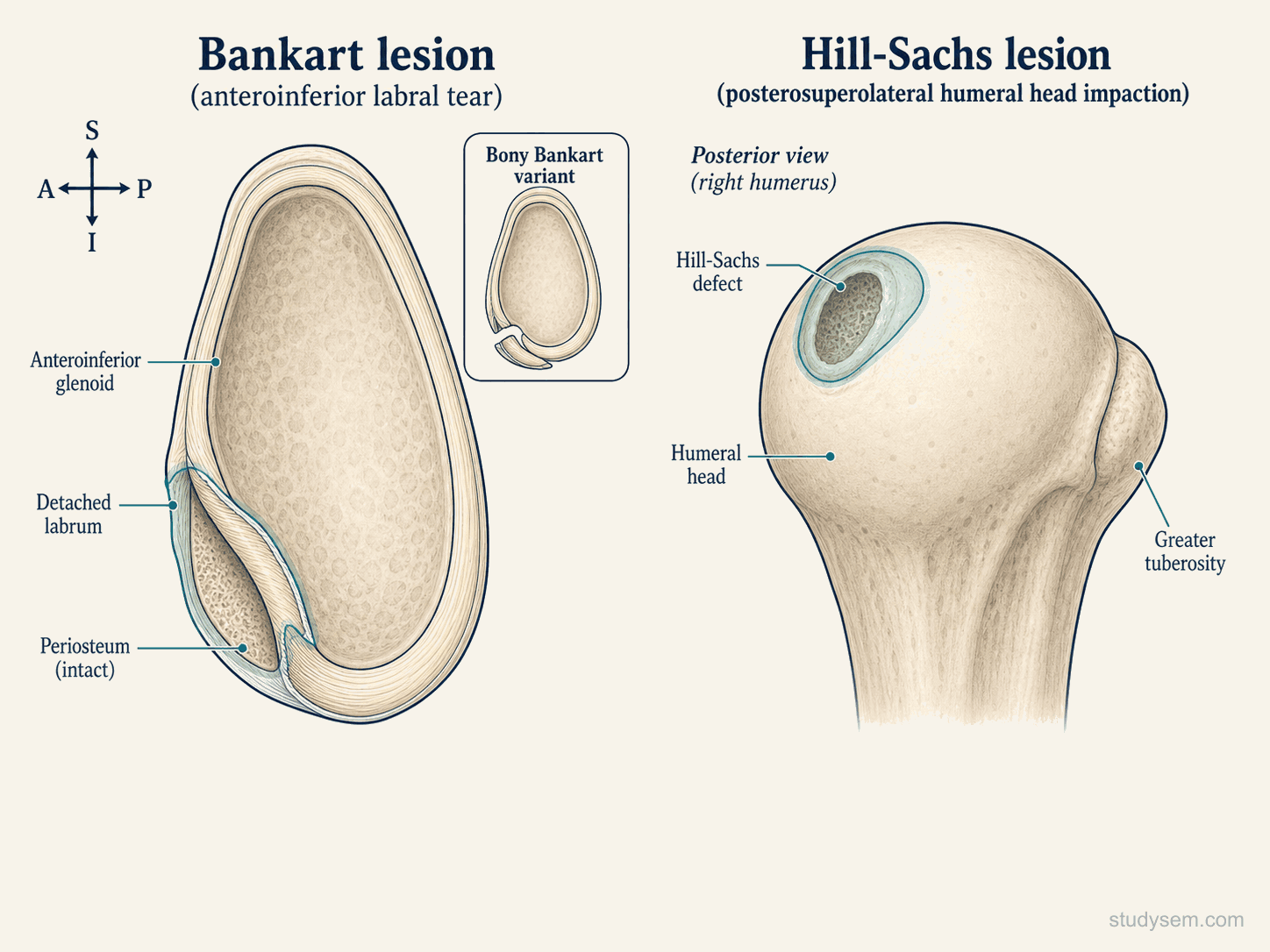 Two-panel comparative diagram of the bipolar lesion pattern after anterior glenohumeral dislocation: anteroinferior labral tear (Bankart lesion) and posterosuperolateral humeral head impaction (Hill-Sachs lesion).