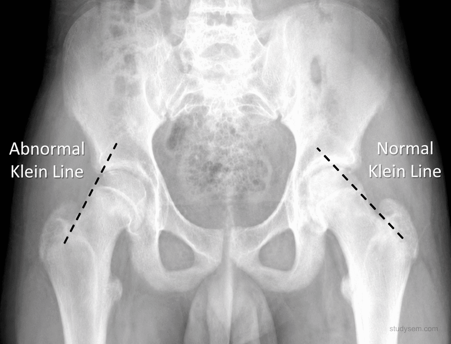 Frog-leg lateral hip radiograph in an adolescent demonstrating SUFE: posterior and inferior displacement of the capital femoral epiphysis through the physis, with Klein's line drawn along the superior border of the femoral neck failing to intersect the epiphysis (positive Trethowan's sign). Contralateral hip shown for comparison. Caption notes that the frog-leg lateral is more sensitive than AP for detecting the slip.