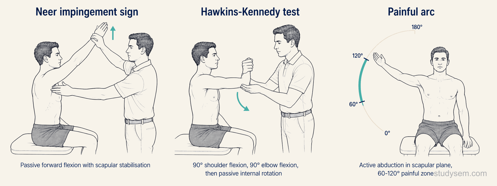 Three-panel illustration of the standard provocation tests for subacromial pain syndrome: painful arc 60-120 degrees, Neer's test, and Hawkins-Kennedy test.