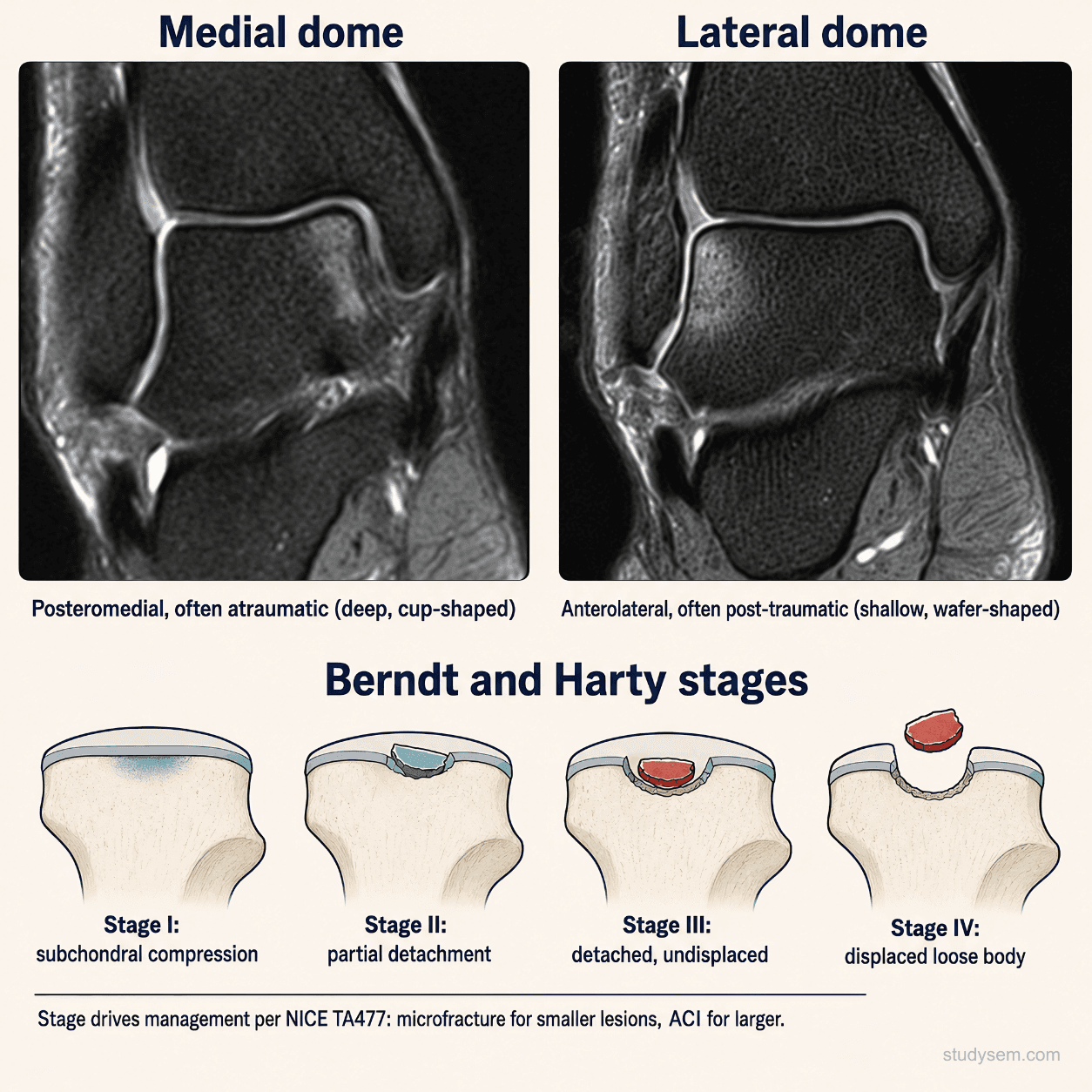 Coronal MRI of the talar dome comparing a posteromedial osteochondral lesion (deeper, cup-shaped, often atraumatic) with an anterolateral osteochondral lesion (shallower, wafer-shaped, typically post-traumatic)