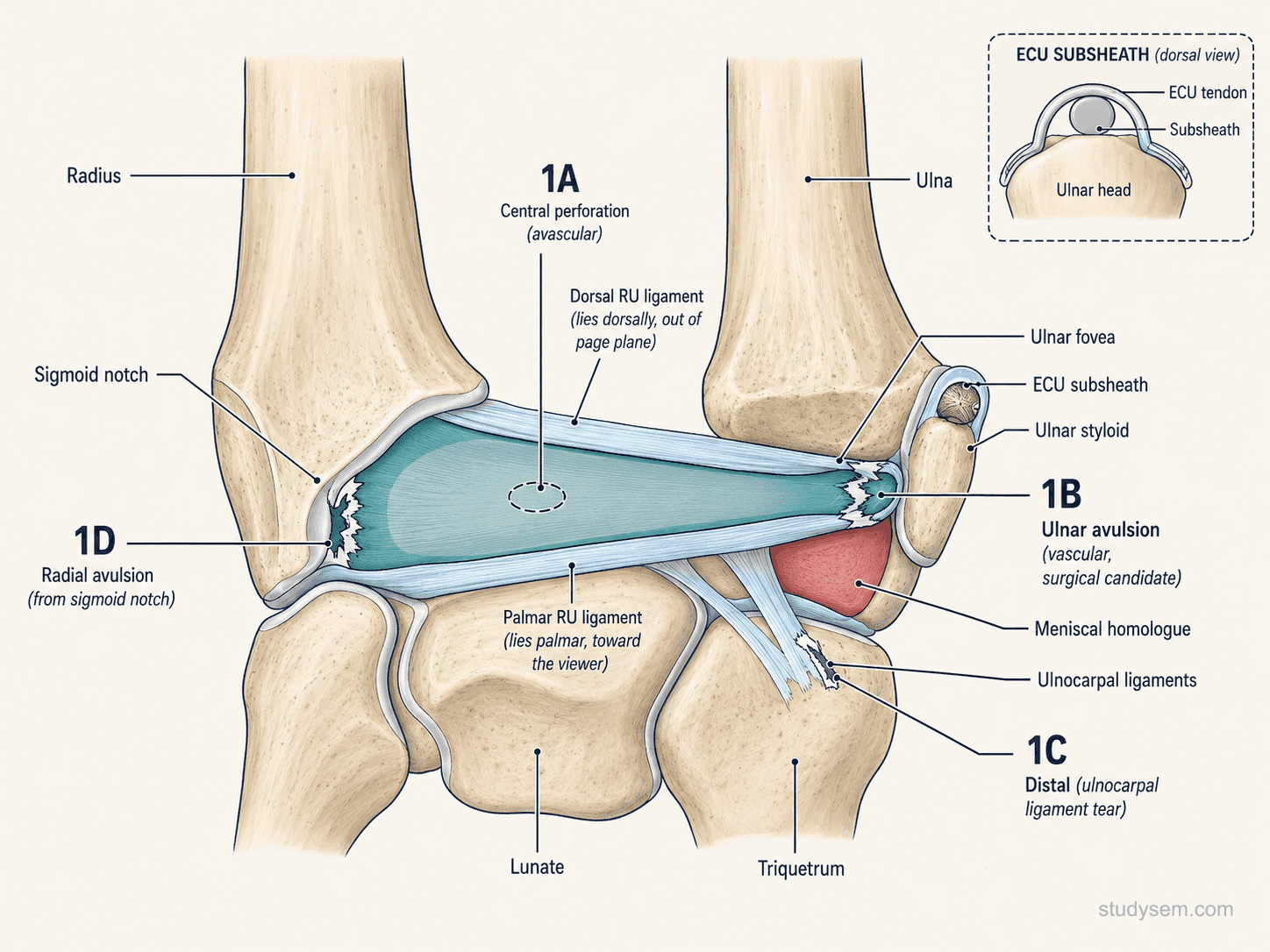 Coronal view of the TFCC showing the articular disc, dorsal and palmar radioulnar ligaments, meniscal homologue, and ECU subsheath with Palmer classification zones 1A through 1D annotated.