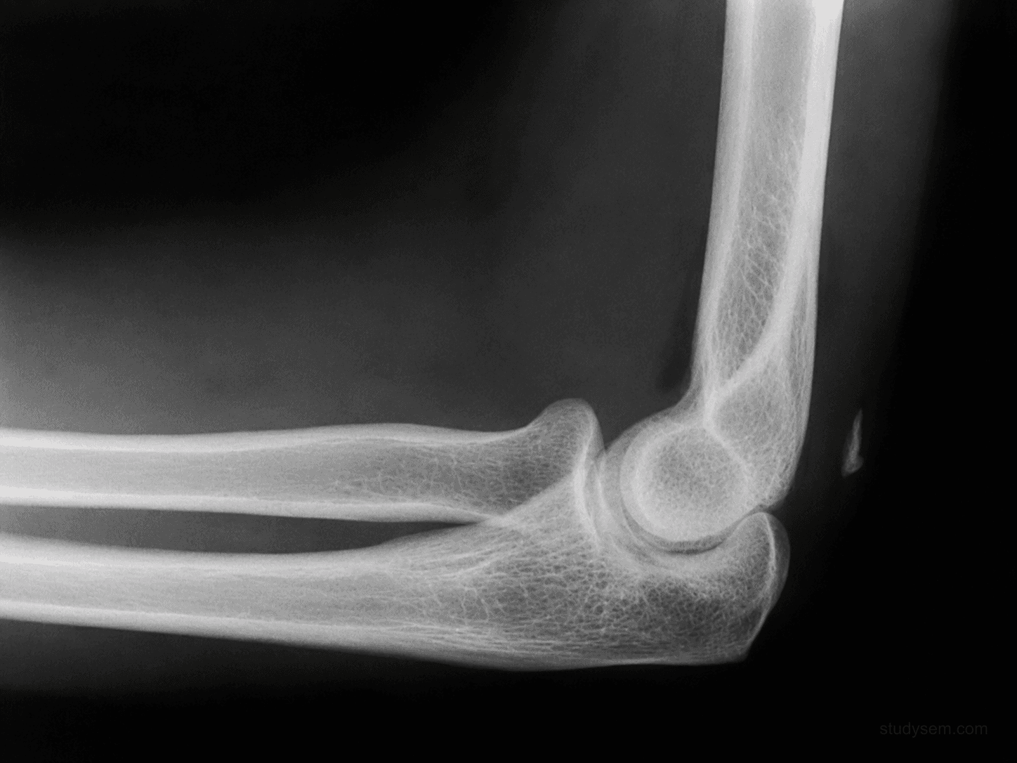 Lateral elbow radiograph appearance showing the flake sign - a small bony fragment avulsed from the olecranon by the triceps tendon.