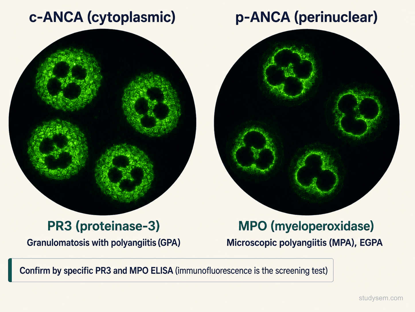 Side-by-side indirect immunofluorescence images showing c-ANCA cytoplasmic granular staining of neutrophils (anti-PR3, associated with GPA) and p-ANCA perinuclear staining (anti-MPO, associated with MPA and EGPA), with note that PR3 and MPO ELISA confirms the antibody specificity
