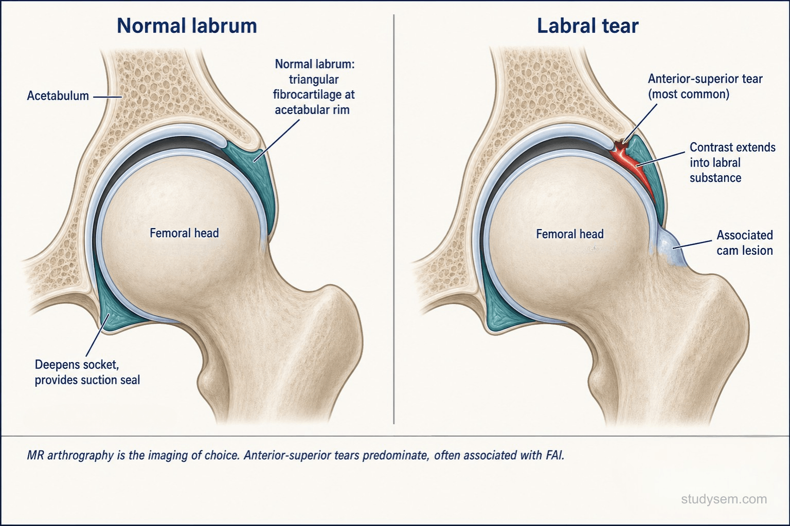 Two-panel diagram showing normal acetabular labrum versus labral tear with contrast extending into the labral substance at the anterior-superior region and associated cam lesion