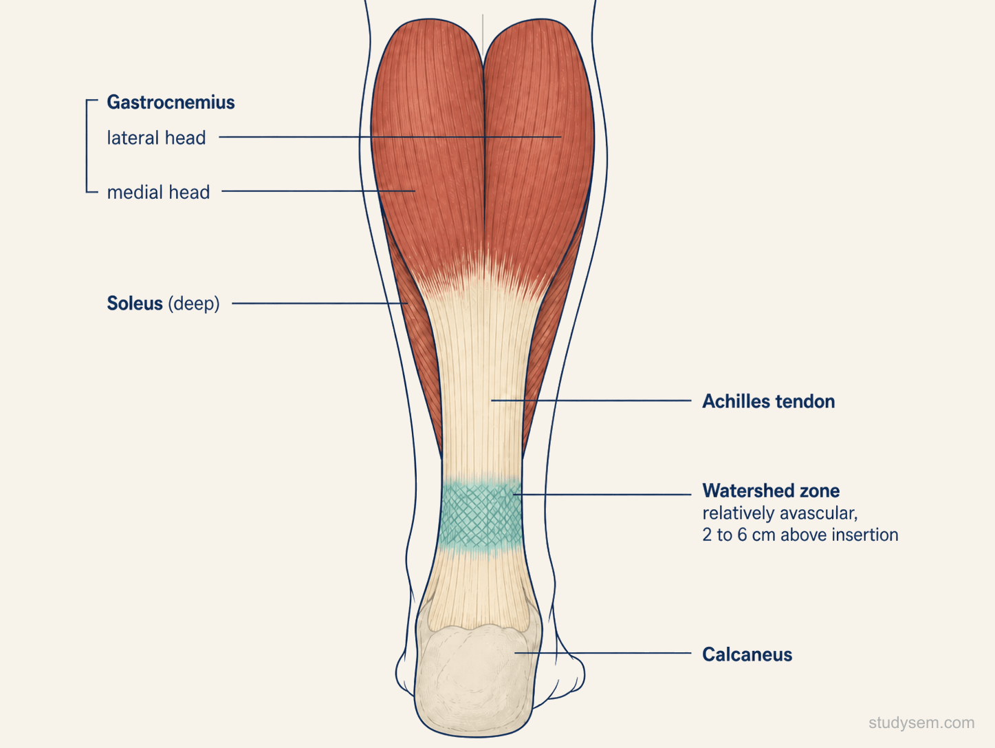 Posterior anatomical view of the lower leg showing the Achilles tendon receiving fibres from gastrocnemius and soleus and inserting on the calcaneal tuberosity, with the relatively avascular watershed zone highlighted 2 to 6 cm above the insertion.