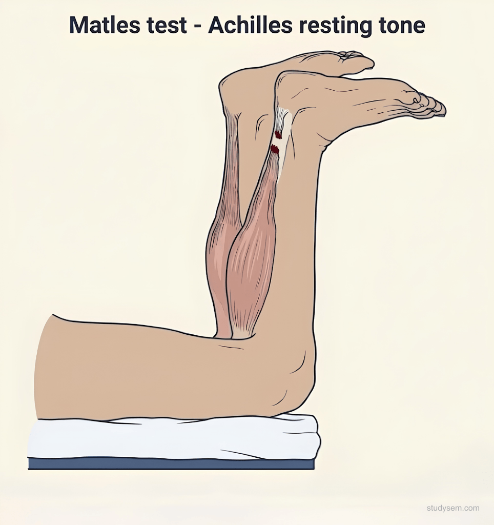 Two-panel examination diagram showing Matles test with patient prone and knees flexed to 90 degrees comparing normal foot in slight plantarflexion to positive test with foot in neutral or dorsiflexion indicating Achilles rupture