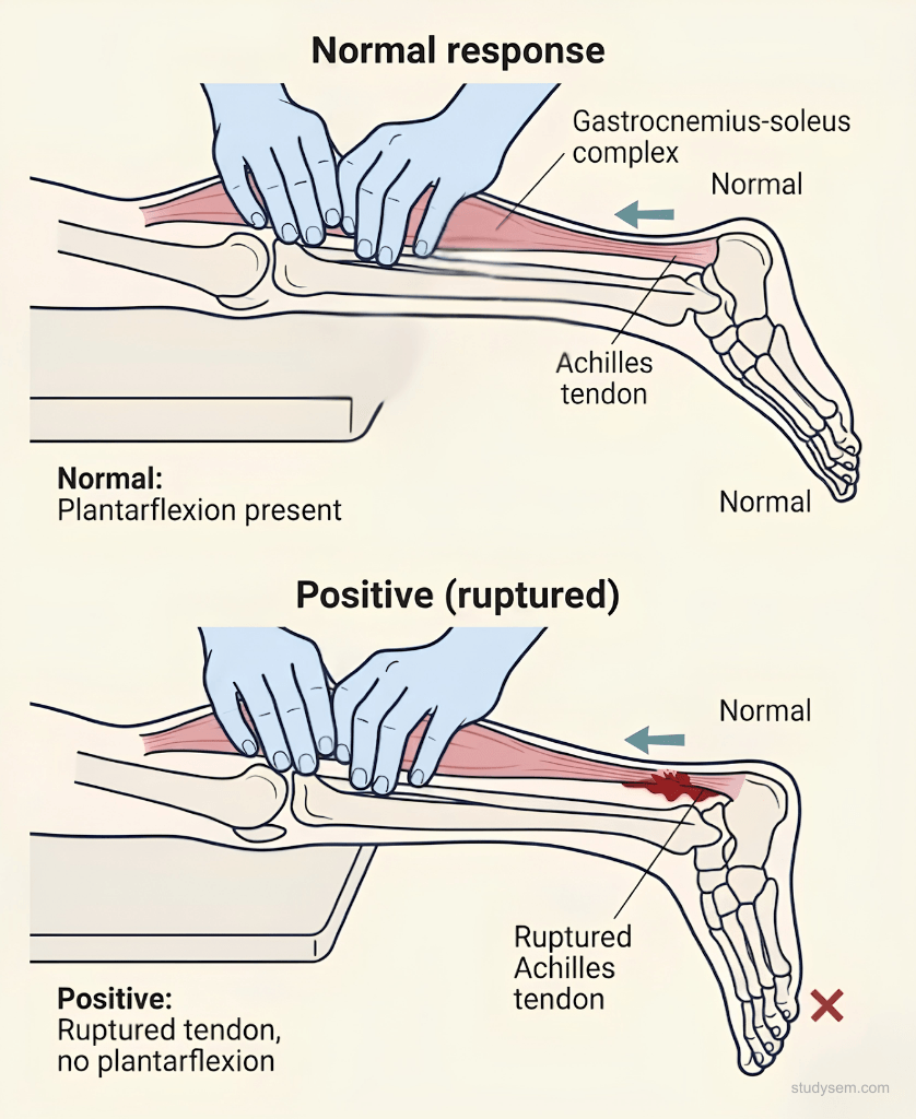 Two-panel examination diagram showing Simmonds-Thompson calf squeeze test with normal plantarflexion response on the left and absent plantarflexion indicating complete Achilles rupture on the right