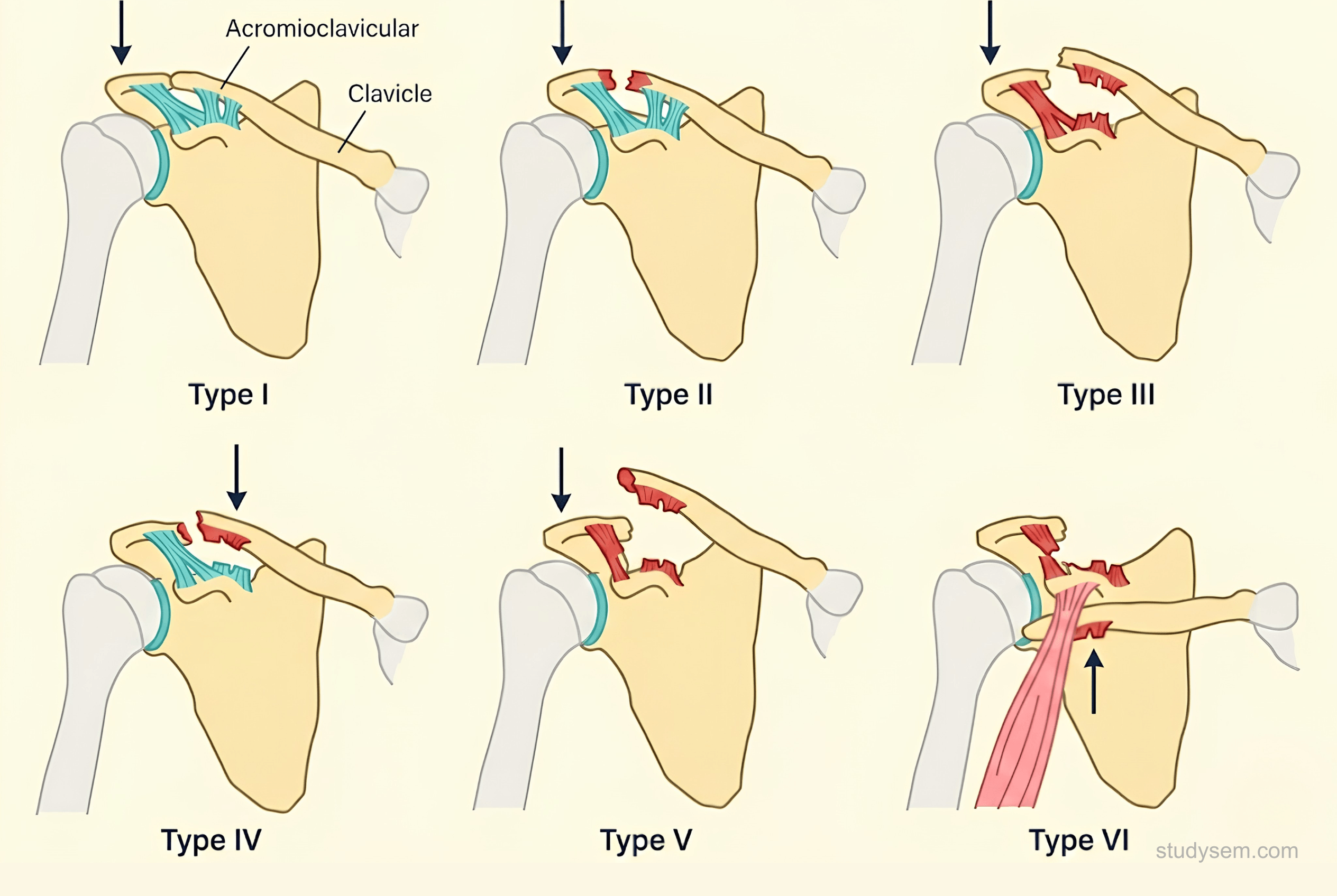 Six-panel diagram of the Rockwood classification of acromioclavicular joint injury, showing the progressive disruption of the AC ligament, coracoclavicular ligaments, and deltotrapezial fascia from Grade I (sprain) through Grade VI (inferior displacement of the clavicle).