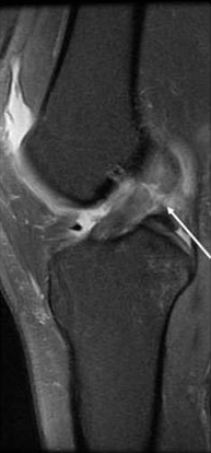 Sagittal T2-weighted MRI of the knee showing complete anterior cruciate ligament rupture with discontinuous fibres and surrounding oedema