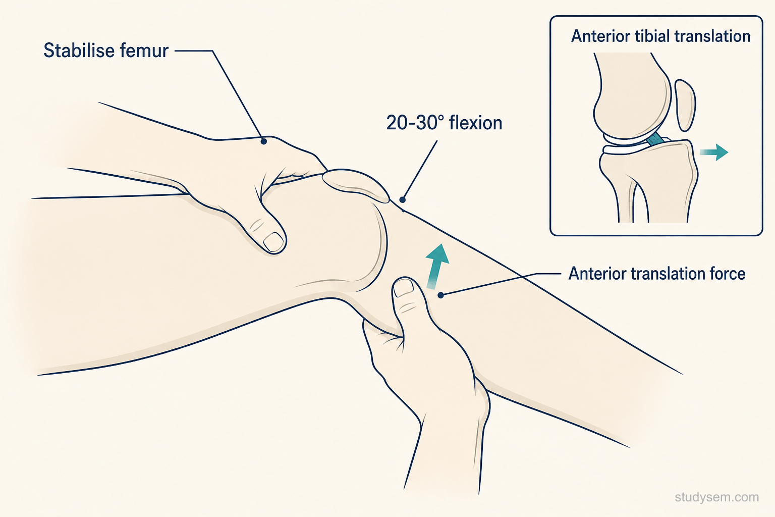 Illustration of the Lachman test - patient supine with knee at 20-30 degrees flexion, examiner stabilises the distal femur and translates the proximal tibia anteriorly, with an inset showing increased anterior tibial translation